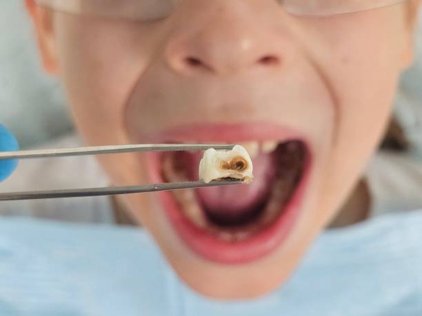 Best Emergency Denture Repair in Martinsburg, WV